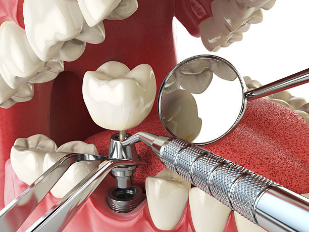 Best Broken or Chipped Tooth Repair in Ridgely, MD